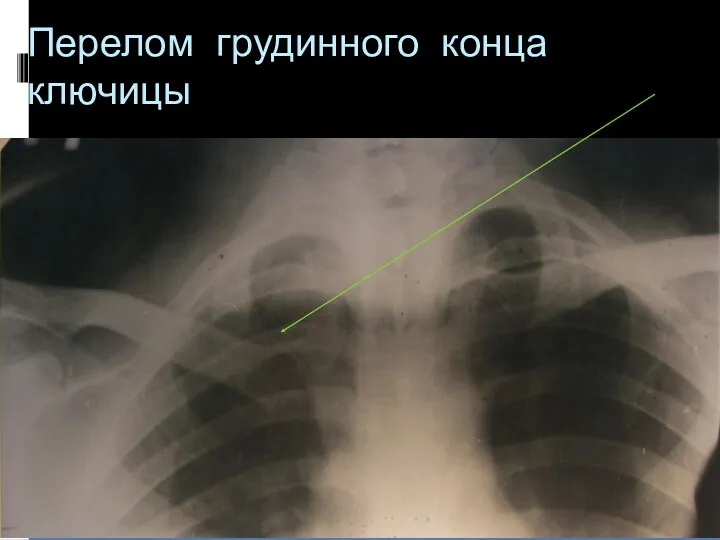 Перелом грудинного конца ключицы