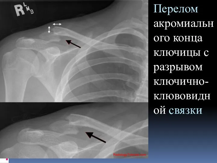 Перелом акромиального конца ключицы с разрывом ключично-клювовидной связки