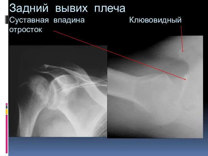 Задний вывих плеча Суставная впадина Клювовидный отросток