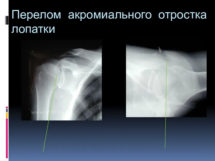 Перелом акромиального отростка лопатки