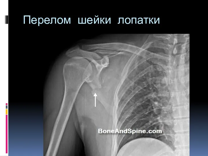 Перелом шейки лопатки