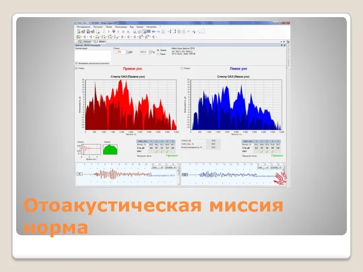 Отоакустическая миссия норма