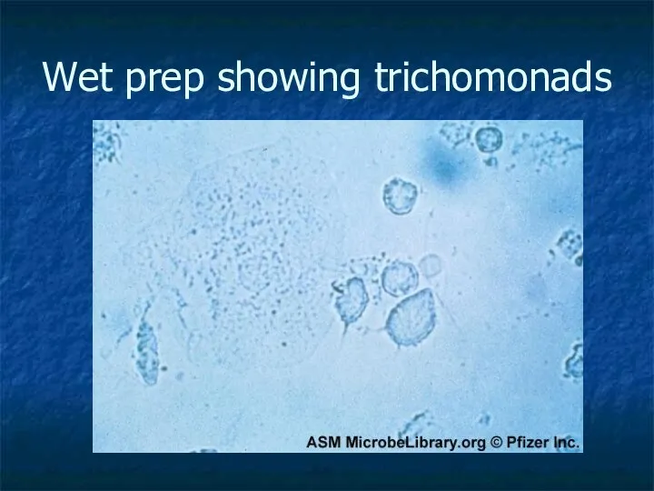 Wet prep showing trichomonads