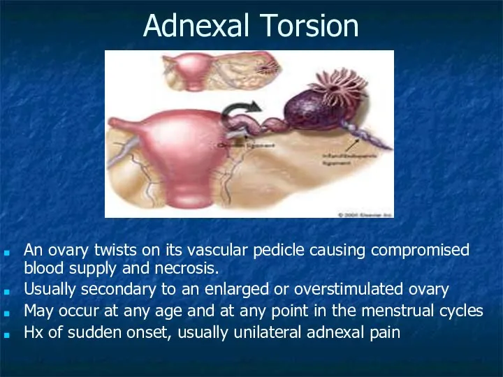 Adnexal Torsion An ovary twists on its vascular pedicle causing