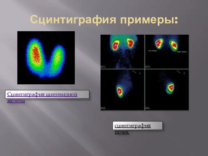 Сцинтиграфия примеры: Сцинтиграфия щитовидной железы сцинтиграфия почек