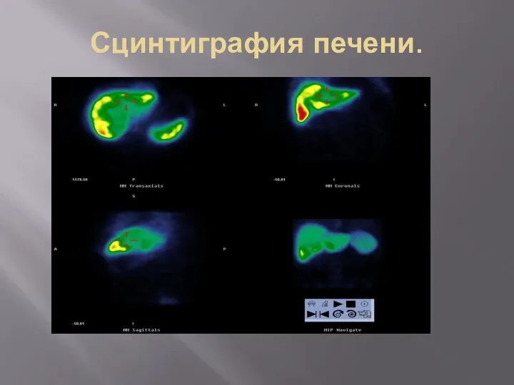 Сцинтиграфия печени.