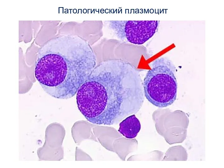Патологический плазмоцит