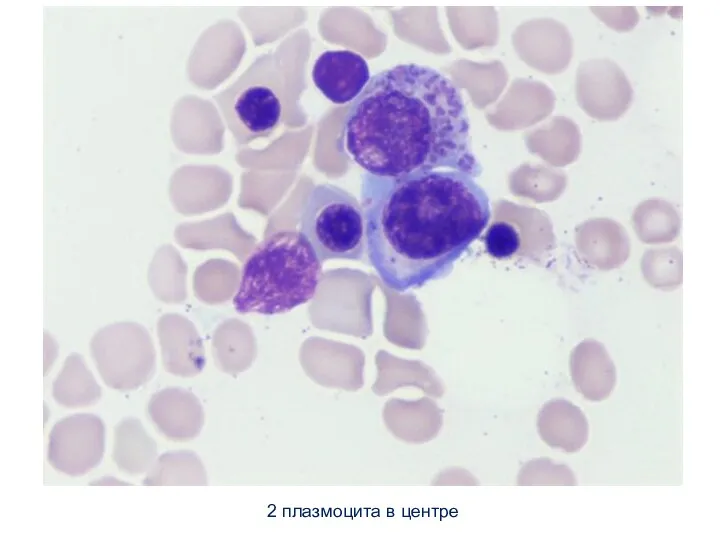 2 плазмоцита в центре