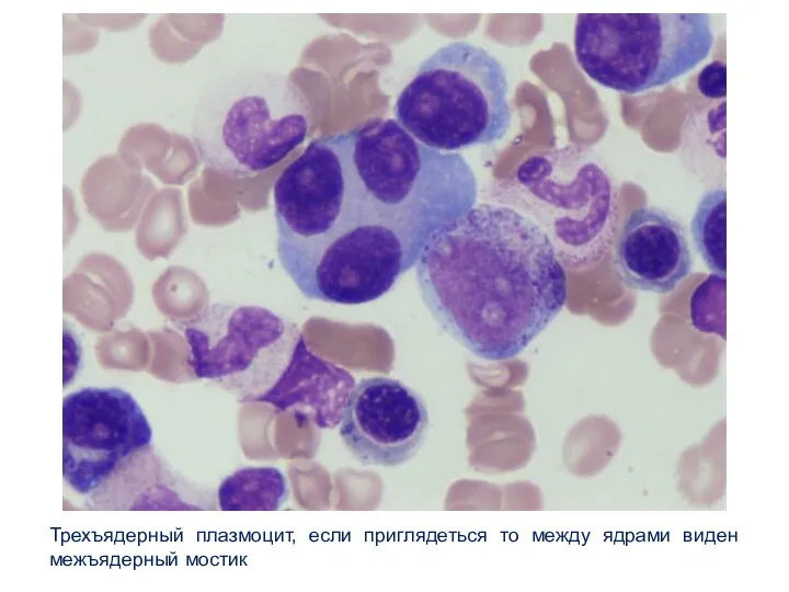Трехъядерный плазмоцит, если приглядеться то между ядрами виден межъядерный мостик