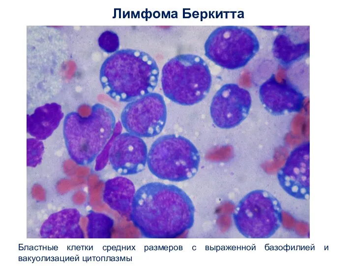 Лимфома Беркитта Бластные клетки средних размеров с выраженной базофилией и вакуолизацией цитоплазмы