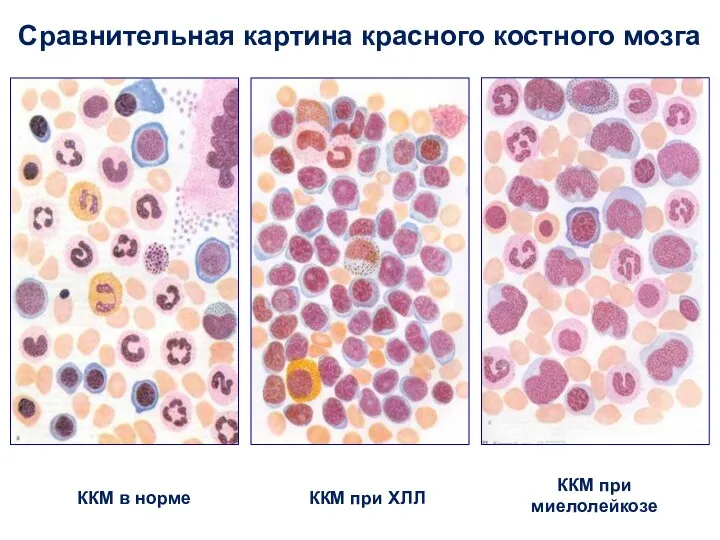 ККМ в норме Сравнительная картина красного костного мозга ККМ при ХЛЛ ККМ при миелолейкозе
