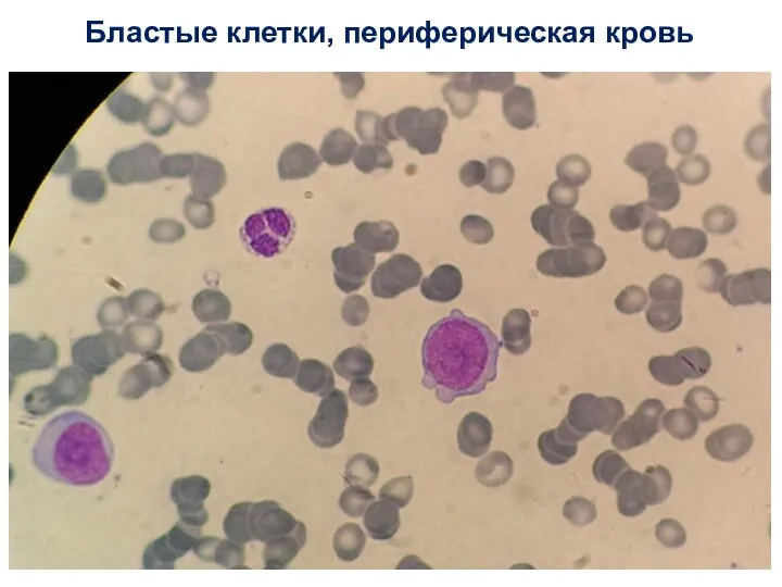 Бластые клетки, периферическая кровь