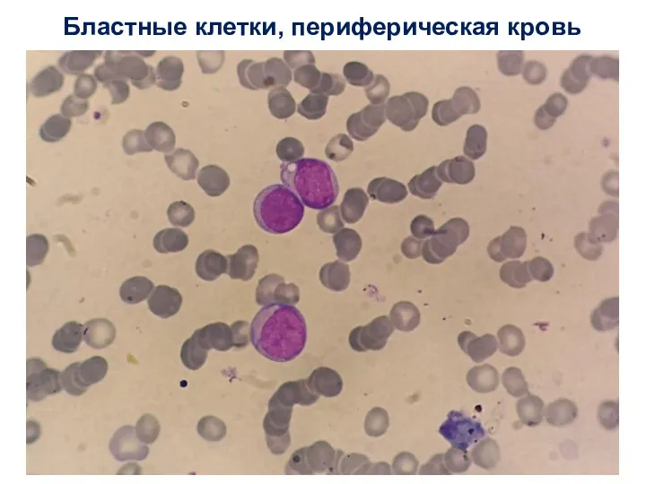 Бластные клетки, периферическая кровь