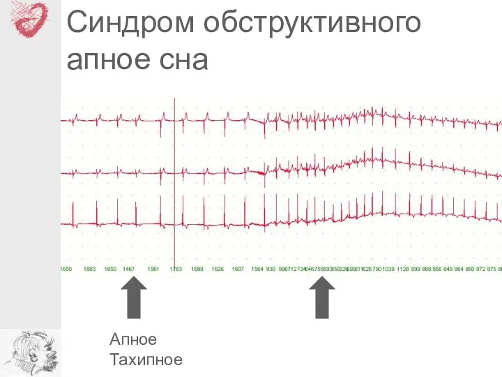 Синдром обструктивного апное сна Апное Тахипное