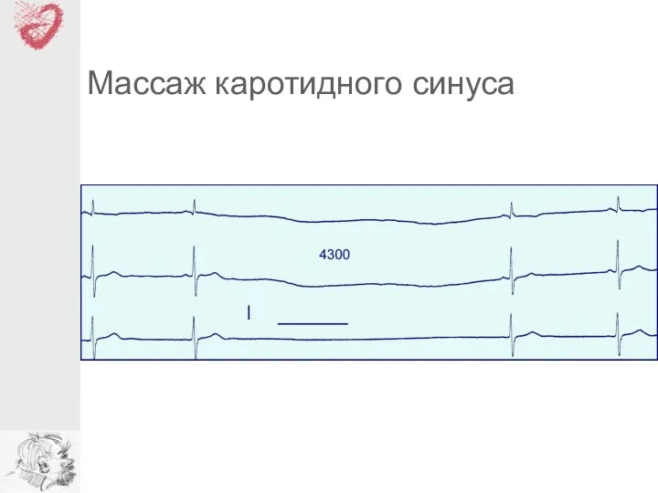 Массаж каротидного синуса