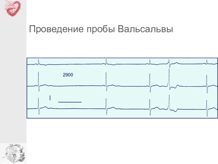 Проведение пробы Вальсальвы