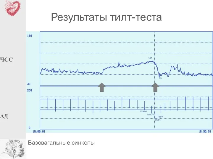 Результаты тилт-теста Вазовагальные синкопы ЧСС АД