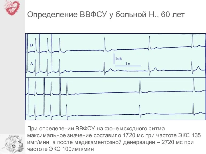 Определение ВВФСУ у больной Н., 60 лет При определении ВВФСУ