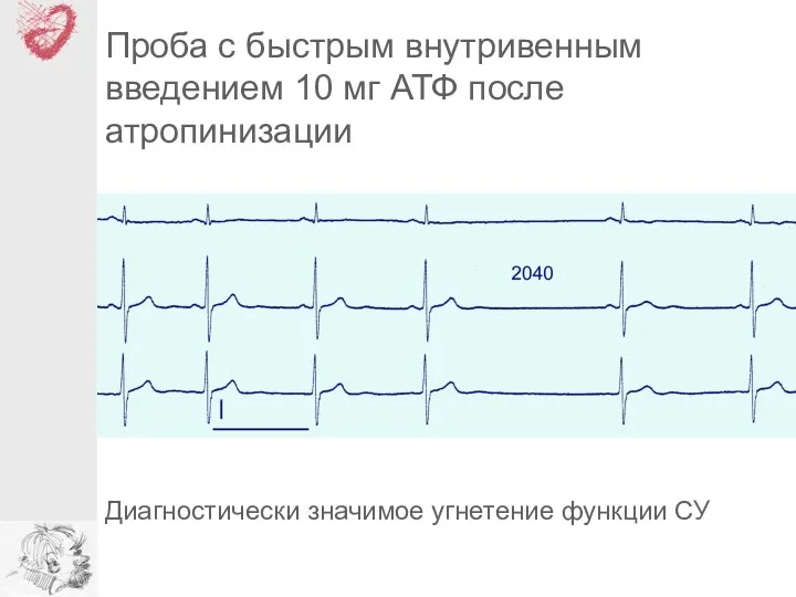 Проба с быстрым внутривенным введением 10 мг АТФ после атропинизации Диагностически значимое угнетение функции СУ