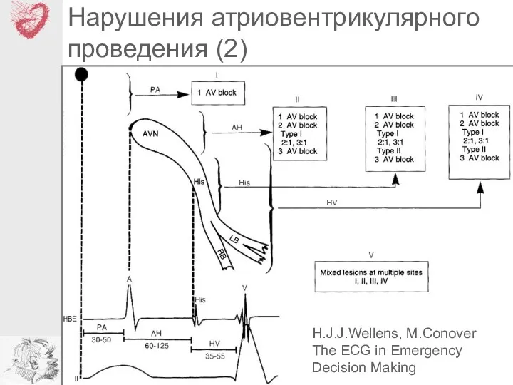 Нарушения атриовентрикулярного проведения (2) H.J.J.Wellens, M.Conover The ECG in Emergency Decision Making