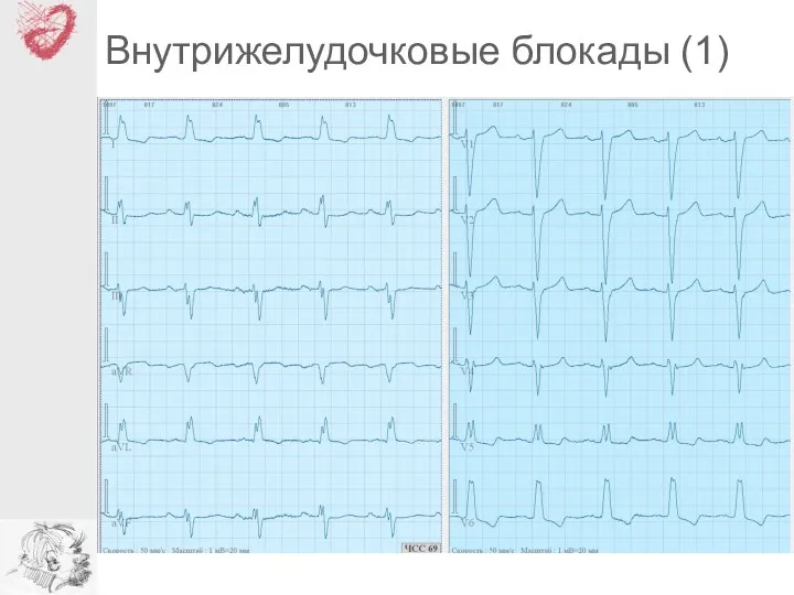 Внутрижелудочковые блокады (1)