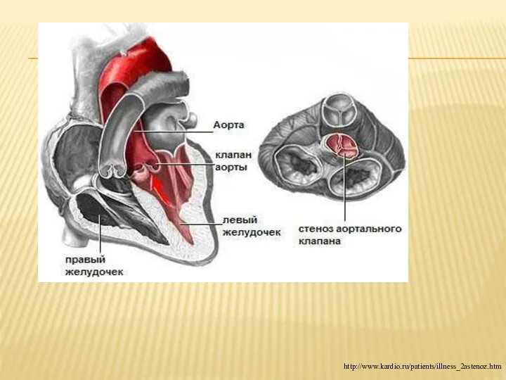 http://www.kardio.ru/patients/illness_2astenoz.htm