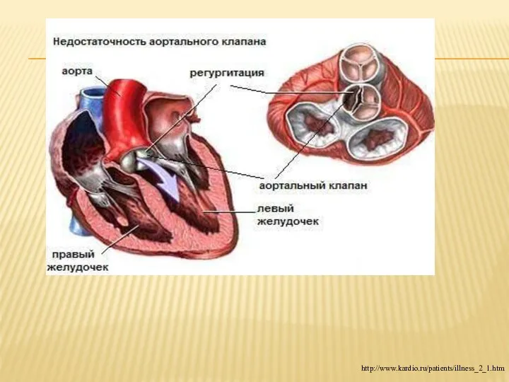 http://www.kardio.ru/patients/illness_2_1.htm