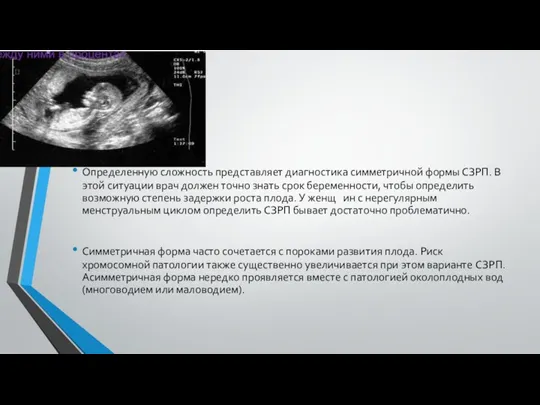 Определенную сложность представляет диагностика симметричной формы СЗРП. В этой ситуации врач должен точно