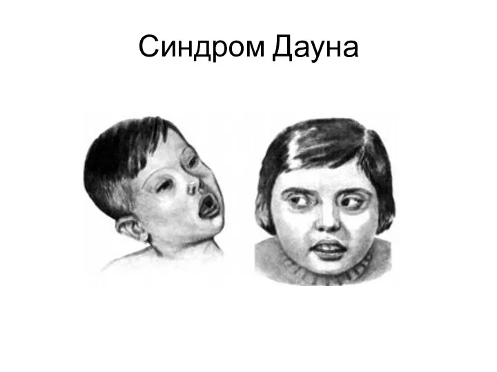 Синдром Дауна