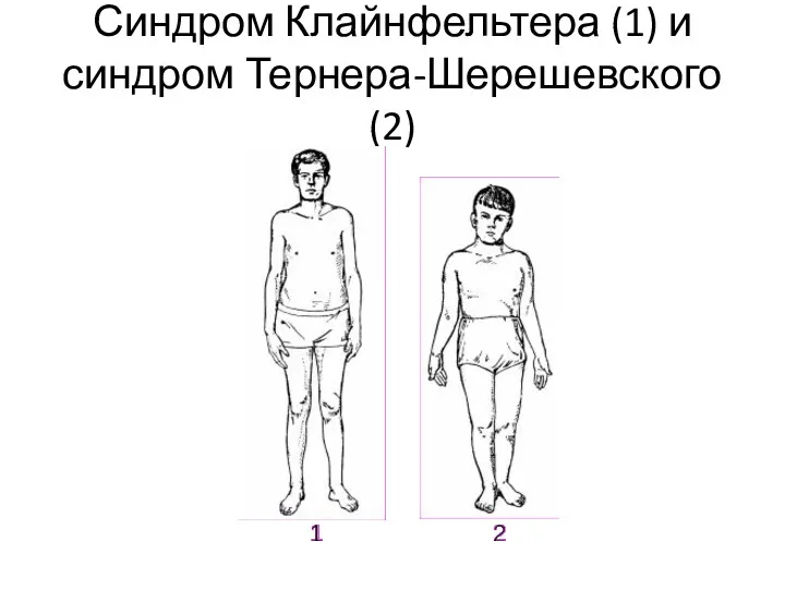 Синдром Клайнфельтера (1) и синдром Тернера-Шерешевского (2)