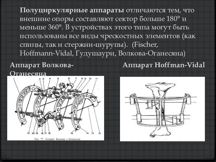 Полуциркулярные аппараты отличаются тем, что внешние опоры составляют сектор больше