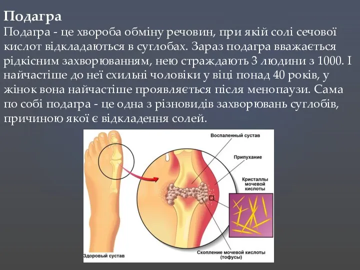 Подагра Подагра - це хвороба обміну речовин, при якій солі