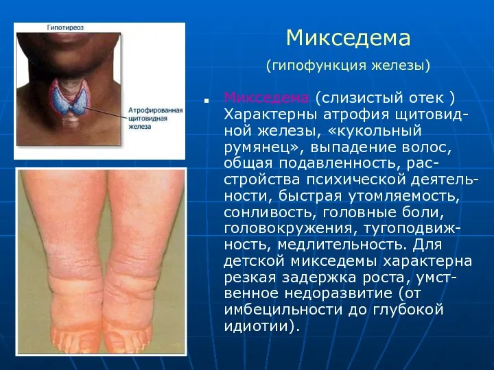 Микседема (слизистый отек ) Характерны атрофия щитовид-ной железы, «кукольный румянец»,