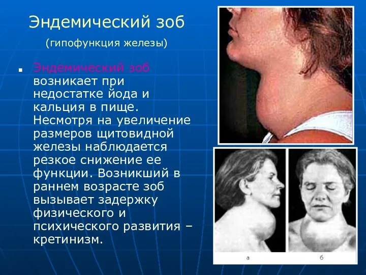 Эндемический зоб возникает при недостатке йода и кальция в пище.