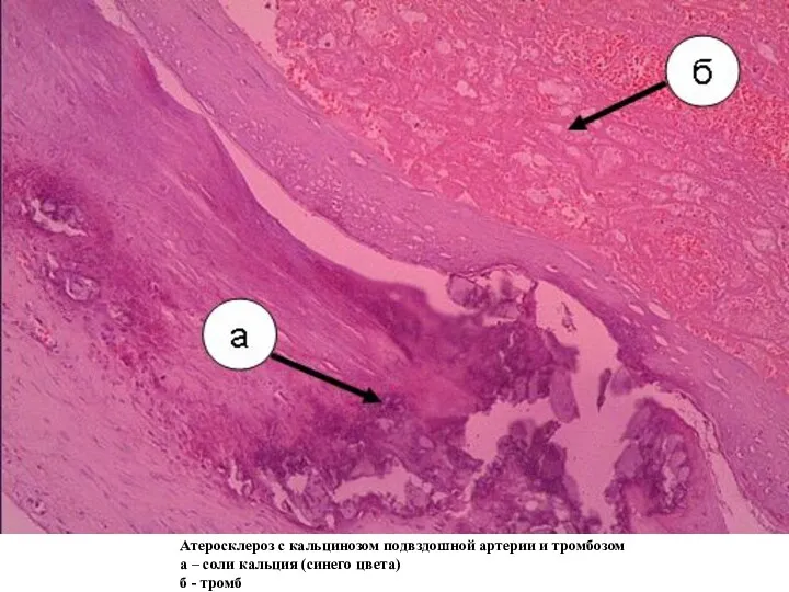 Атеросклероз с кальцинозом подвздошной артерии и тромбозом а – соли кальция (синего цвета) б - тромб