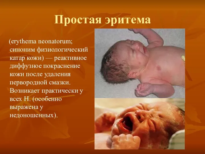 Простая эритема (erythema neonatorum; синоним физиологический катар кожи) — реактивное