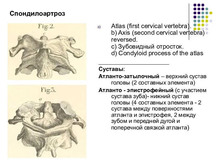 Спондилоартроз Atlas (first cervical vertebra). b) Axis (second cervical vertebra) reversed. c) Зубовидный