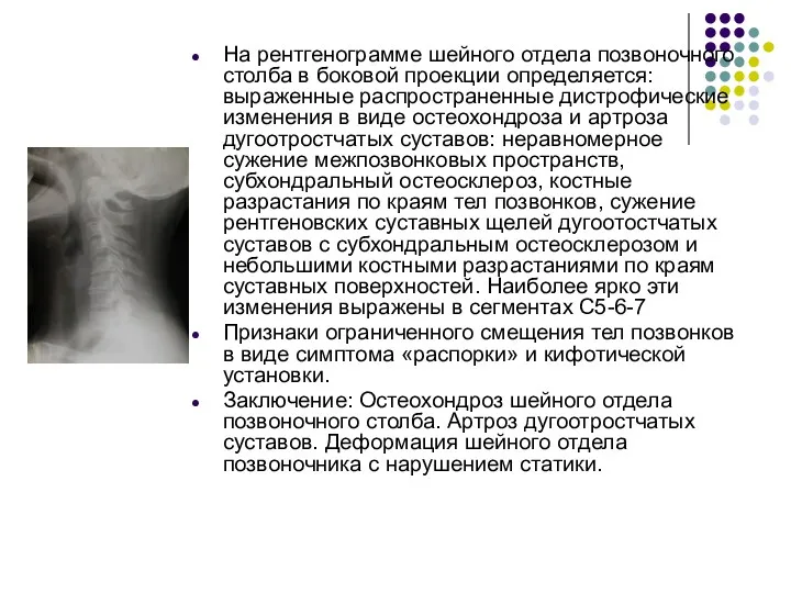 На рентгенограмме шейного отдела позвоночного столба в боковой проекции определяется: выраженные распространенные дистрофические
