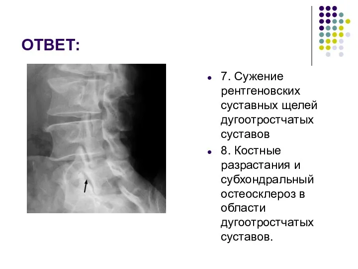 ОТВЕТ: 7. Сужение рентгеновских суставных щелей дугоотростчатых суставов 8. Костные разрастания и субхондральный