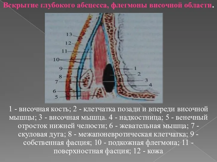 Вскрытие глубокого абсцесса, флегмоны височной области. 1 - височная кость; 2 - клетчатка