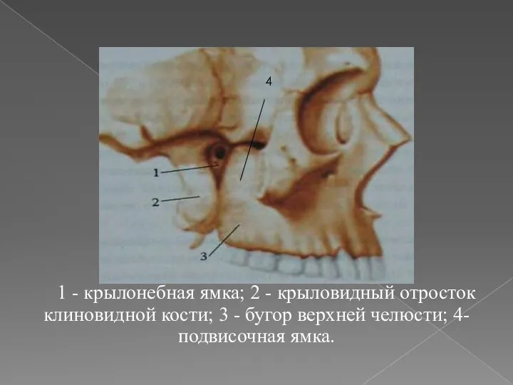 1 - крылонебная ямка; 2 - крыловидный отросток клиновидной кости; 3 - бугор