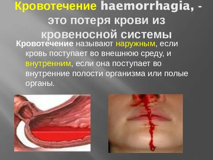 Кровотечение haemorrhagia, -это потеря крови из кровеносной системы Кровотечение называют