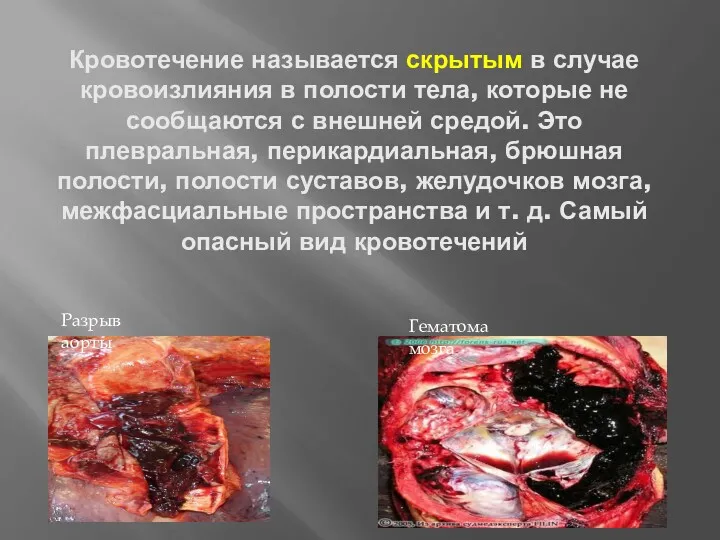 Кровотечение называется скрытым в случае кровоизлияния в полости тела, которые