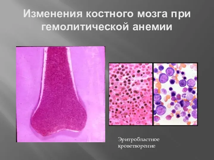 Изменения костного мозга при гемолитической анемии Эритробластное кроветворение