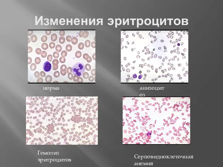 Изменения эритроцитов норма анизоцитоз Гемолиз эритроцитов Серповидноклеточная анемия