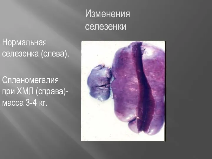 Изменения селезенки Нормальная селезенка (слева). Спленомегалия при ХМЛ (справа)-масса 3-4 кг.