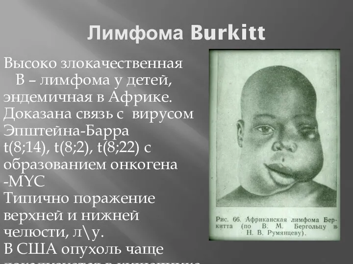 Лимфома Burkitt Высоко злокачественная В – лимфома у детей, эндемичная