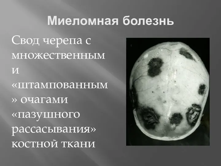 Миеломная болезнь Свод черепа с множественными «штампованным» очагами «пазушного рассасывания» костной ткани