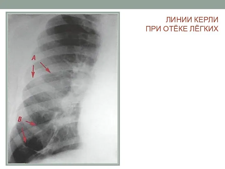 ЛИНИИ КЕРЛИ ПРИ ОТЁКЕ ЛЁГКИХ