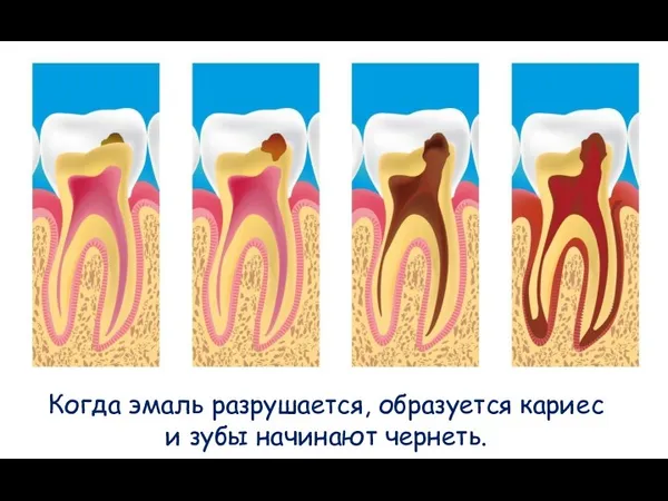 Когда эмаль разрушается, образуется кариес и зубы начинают чернеть.